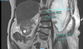 Figure 1: MRI Abdomen showing a large abscess (19.9 cm x 10.9 cm) over the left flank which enhances with contrast administration.
