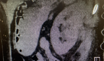 Figure 2a: CT Scan (no contrast) showing near complete resolution of the previously seen left renal abscess following IR drainage.