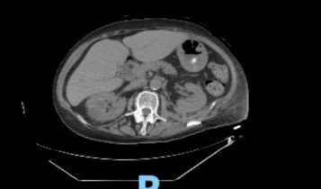 Figure 2b: Axial view of CT Scan (no contrast) showing near complete resolution of the previously seen left renal abscess following IR drainage.